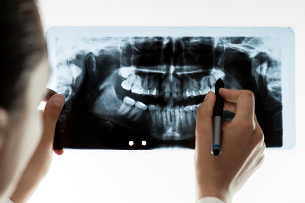 A clinician marking up a dental OPG film